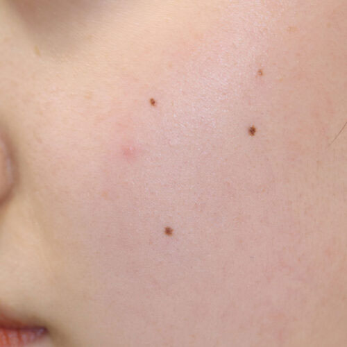 ほくろ除去前