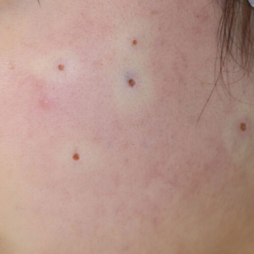 ほくろ除去 直後