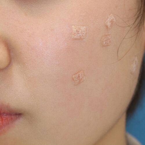 ほくろ除去 治療後のケア 専用テープ