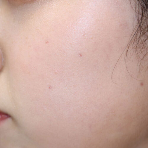 ほくろ除去 10日後