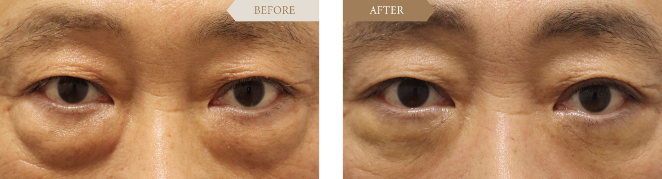 男性 目の下のたるみ・目袋の改善ビフォアアフター1