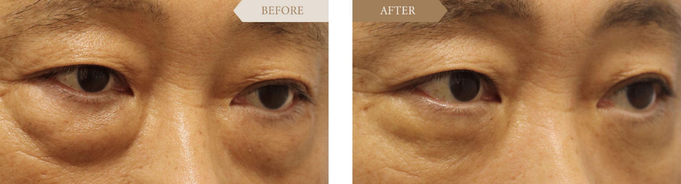 男性 目の下のたるみ・目袋の改善ビフォアアフター2
