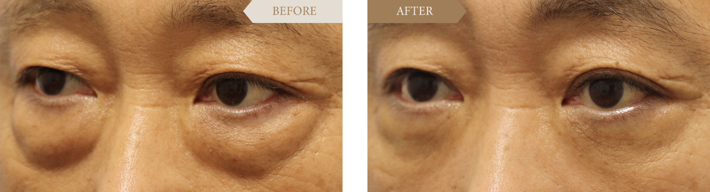 男性 目の下のたるみ・目袋の改善ビフォアアフター3