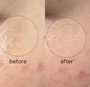 美白ケアには必須‼︎シナール＆トラネキサム酸💊