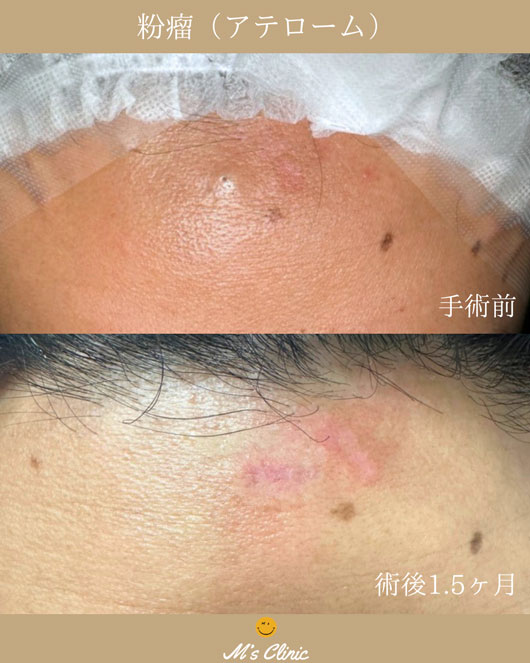 粉瘤治療ビフォアアフター