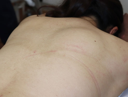 女性の背中にできた大きな脂肪腫の写真