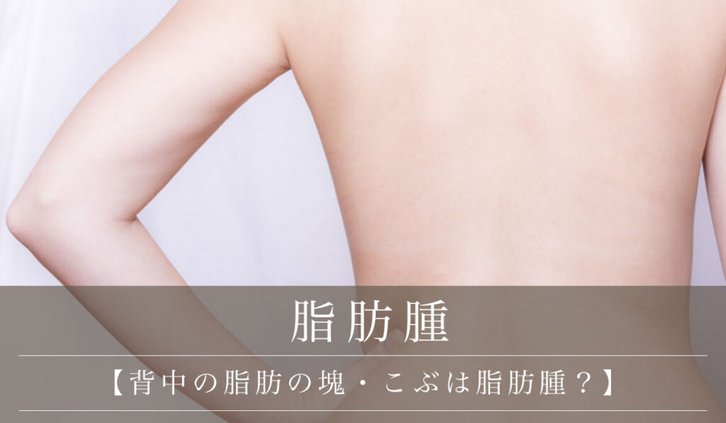 【背中の脂肪の塊・こぶは脂肪腫？】背中にできる原因と症状・治し方