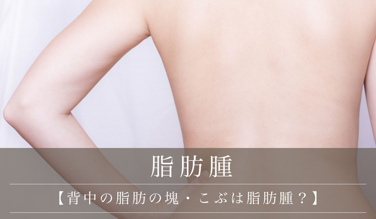 【背中の脂肪の塊・こぶは脂肪腫?】