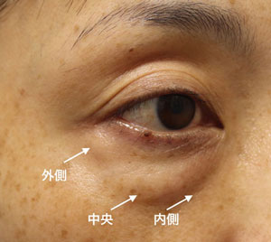 眼窩脂肪「内側・中央・外側」