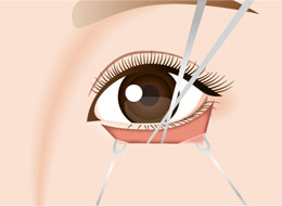 表ハムラ法の切開イラスト