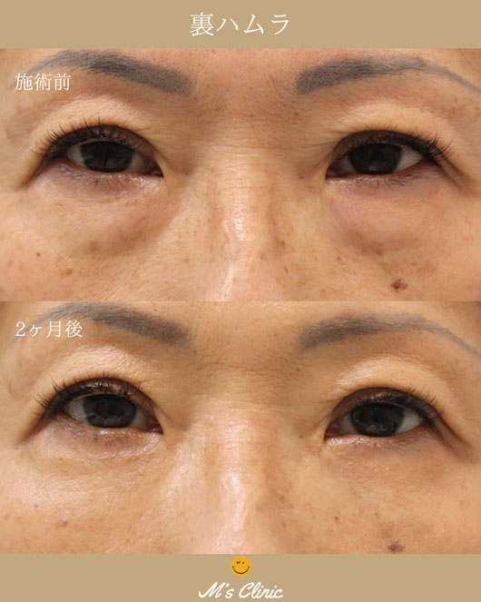 50代女性 裏ハムラ法ビフォアアフター