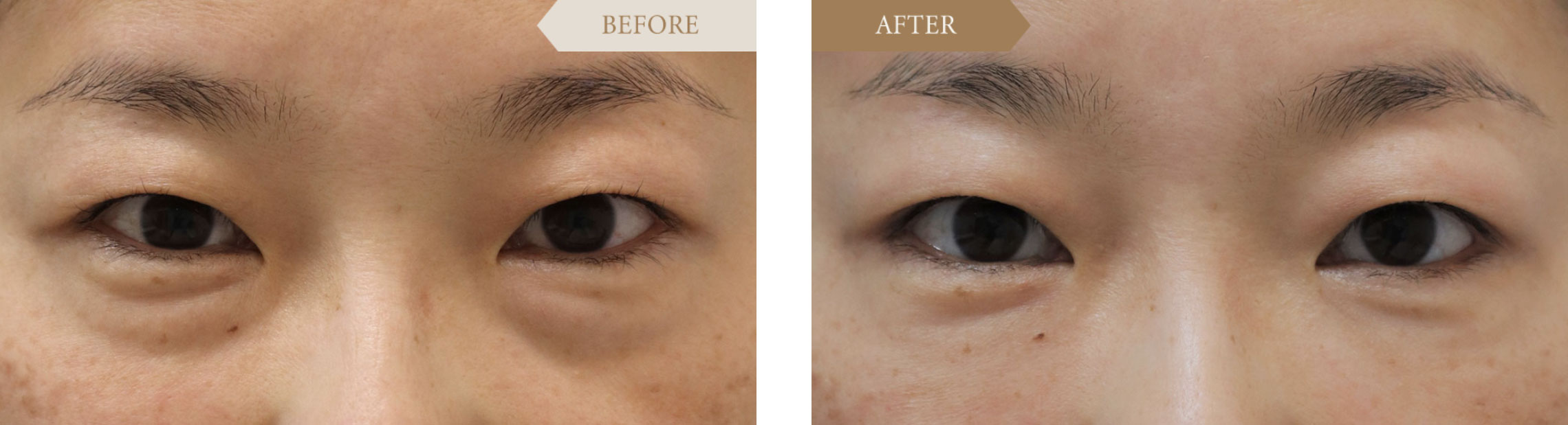 40代/女性 裏ハムラ法ビフォアアフター1