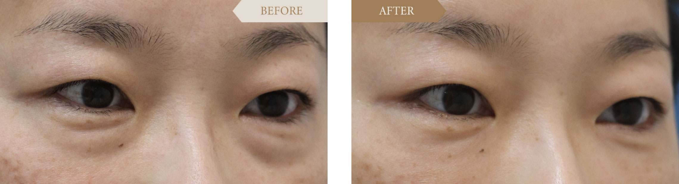 40代/女性 裏ハムラ法ビフォアアフター2