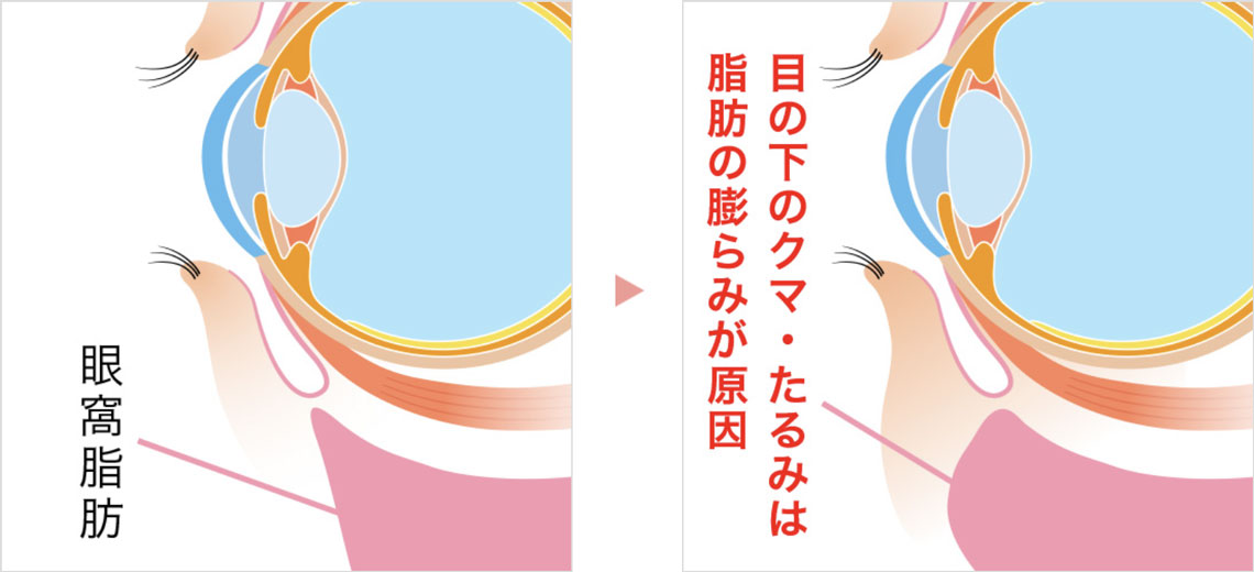 眼窩脂肪のイラスト