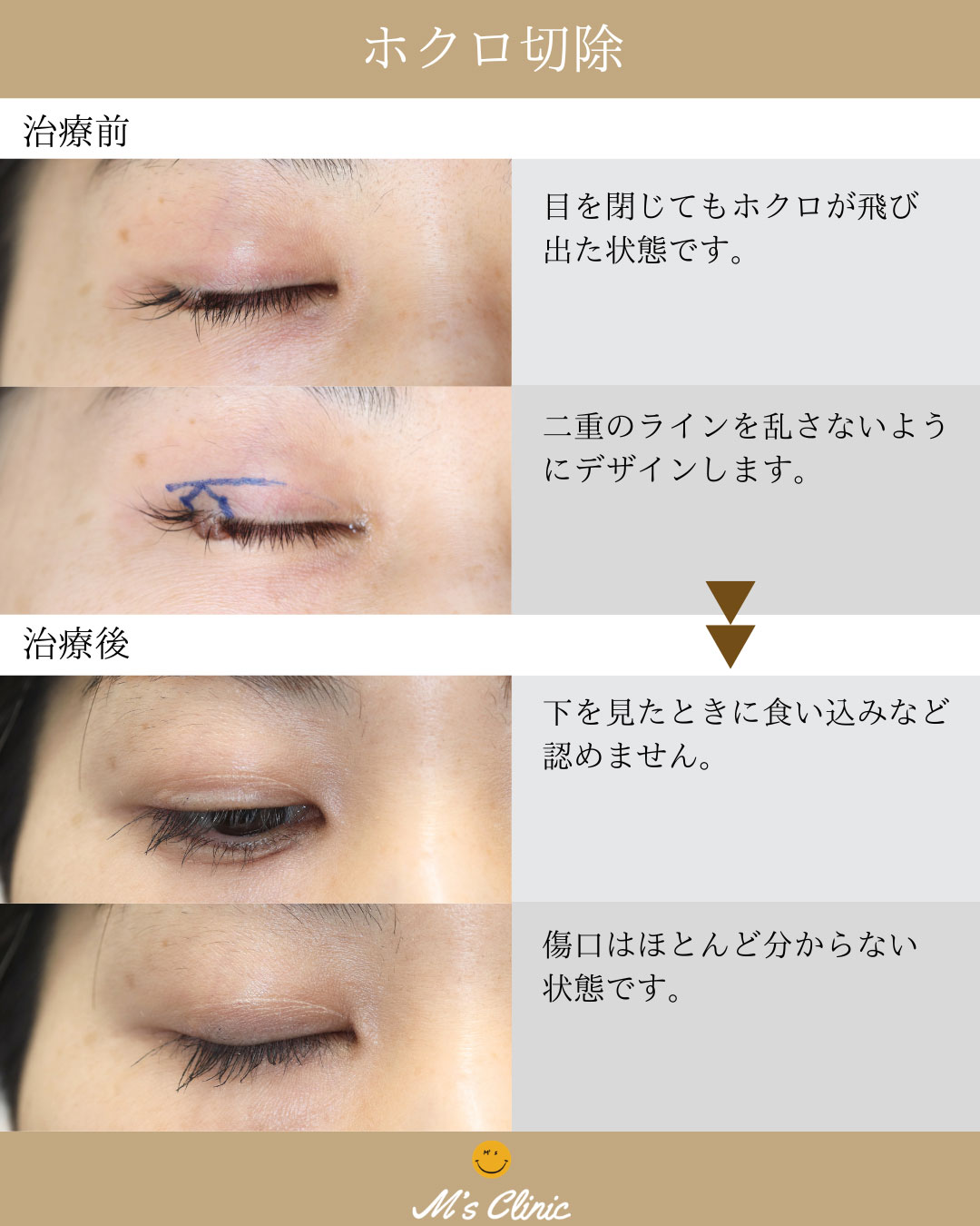 ほくろ切除　治療前・治療後の経過