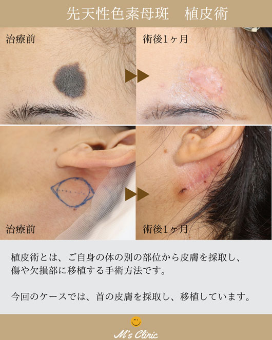 先天性色素母斑 植皮術の説明画像
