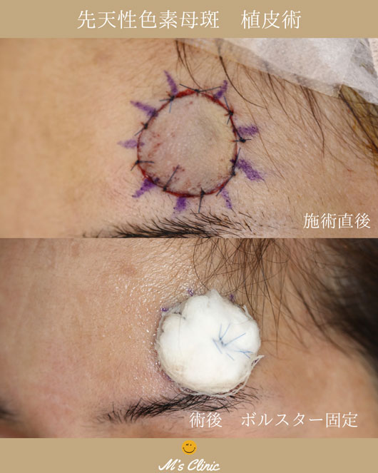 術後のボルスター固定の画像