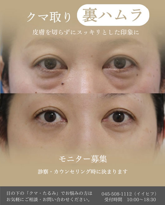 裏ハムラ法キャンペーン