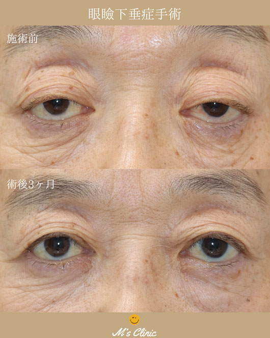 眼瞼下垂症手術ビフォアアフター