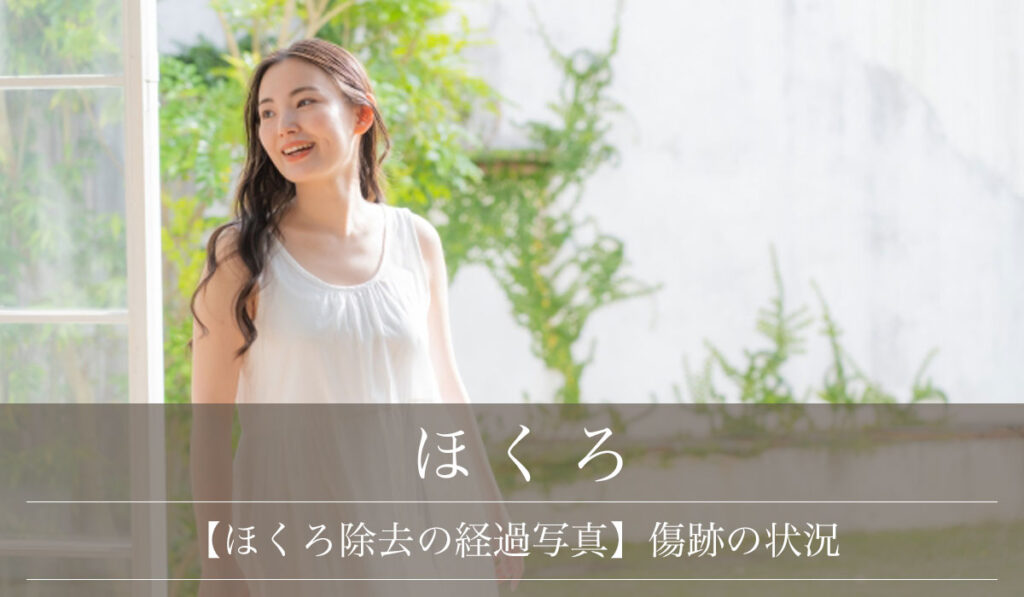 【ほくろ除去の経過写真】手術直後・1週間・1ヶ月・4ヶ月 傷跡の状況