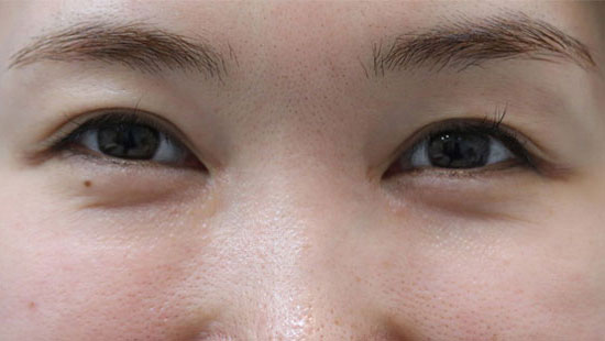 30代 女性の涙袋イメージ