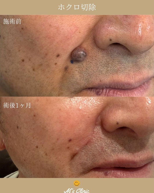 鼻の横にある大きい盛り上がりのあるほくろビフォアアフター