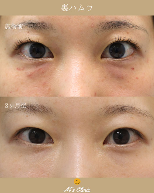 若い女性の裏ハムラ法ビフォアアフター